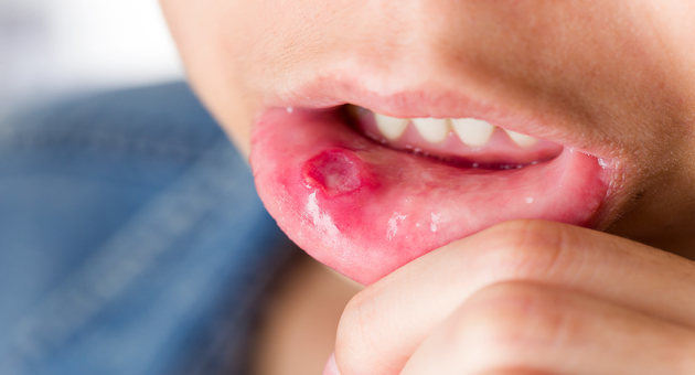 Painful Mouth Ulcer Here Is What You Should Do Tata 1mg Capsules