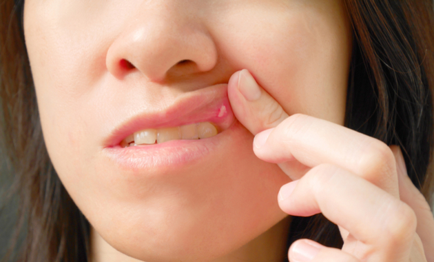 5 Common Causes Of Recurrent Mouth Ulcers Tata 1mg Capsules