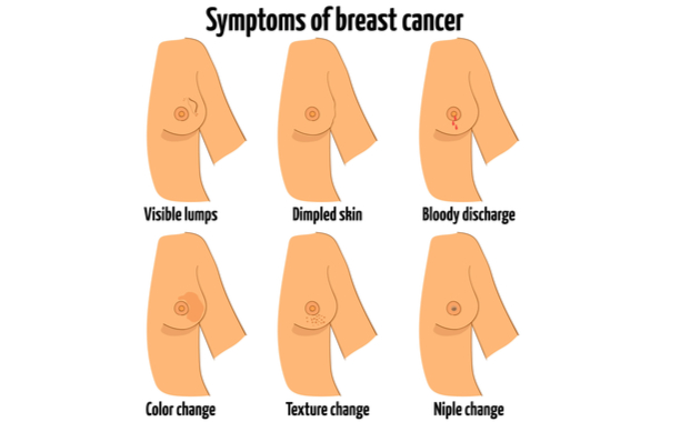 What Causes a Saggy Breast?