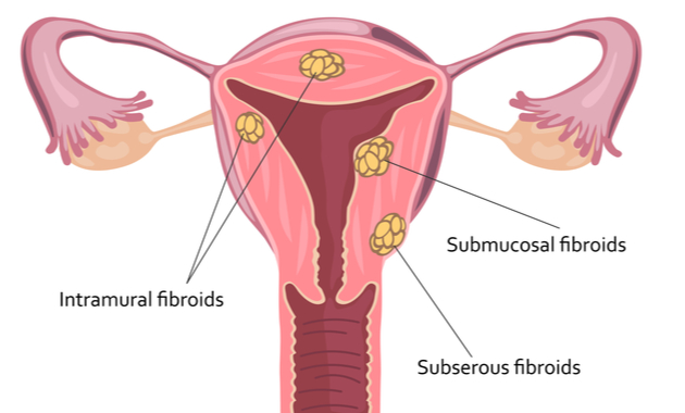 uterus fibroids