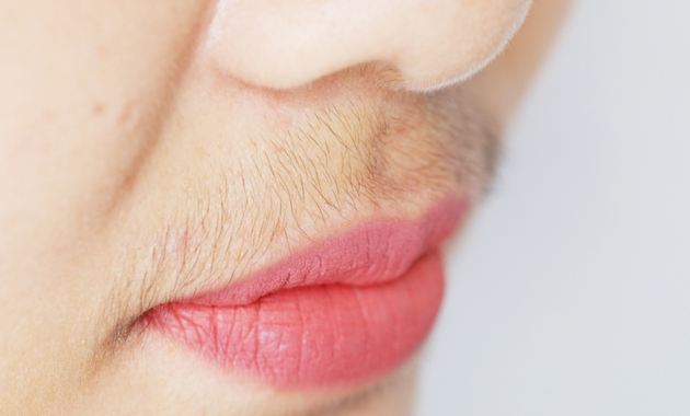 Hirsutism: What It Is, In Women, Causes, PCOS & Treatment